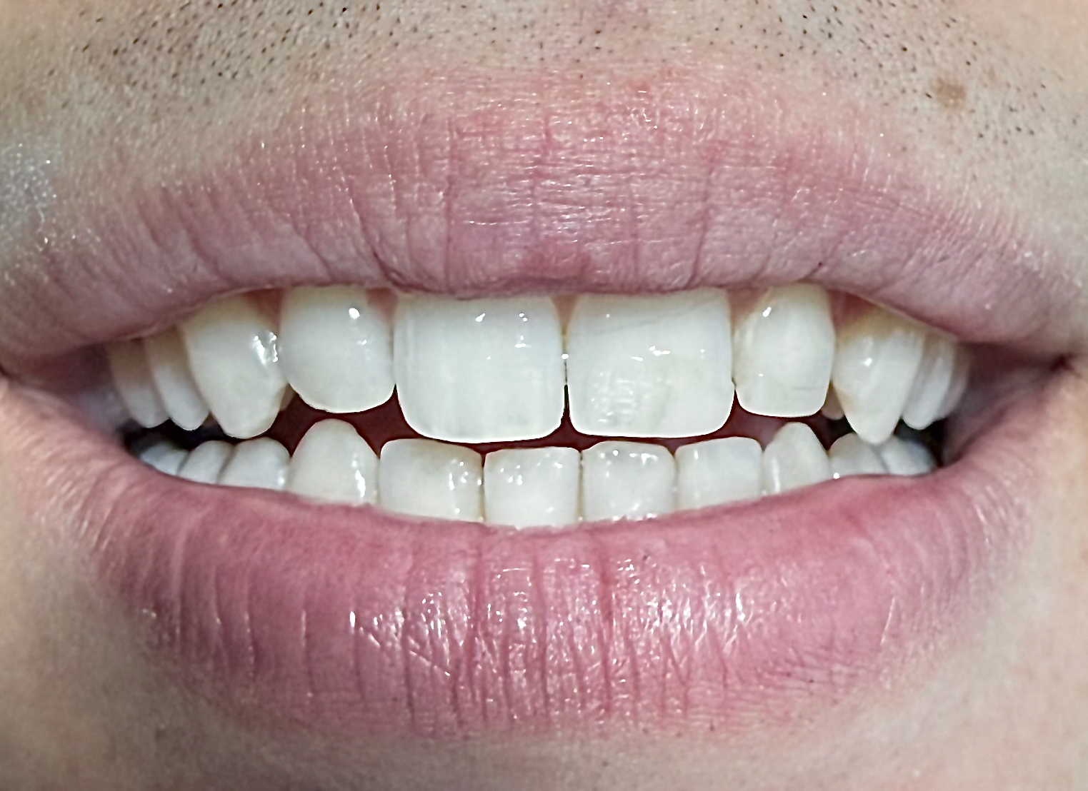 Whitening result after treatment